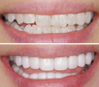 深圳冷光美白牙齿多少钱