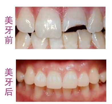 深圳烤瓷牙,友睦烤瓷牙